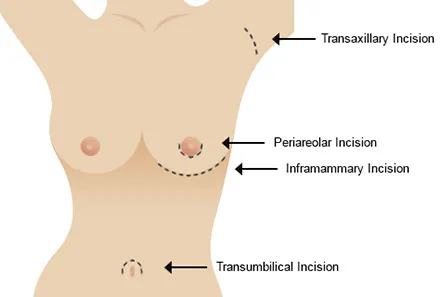 Breast Augmentation incisions diagram